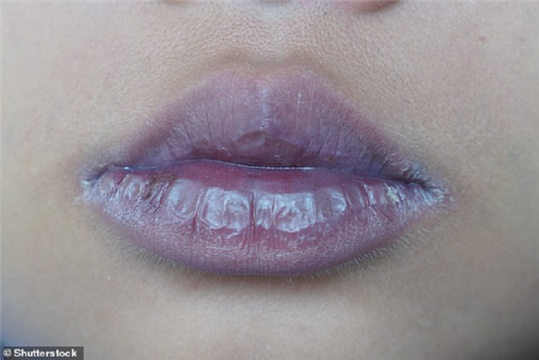 嘴唇发灰或是新冠：专家公布多条新症状