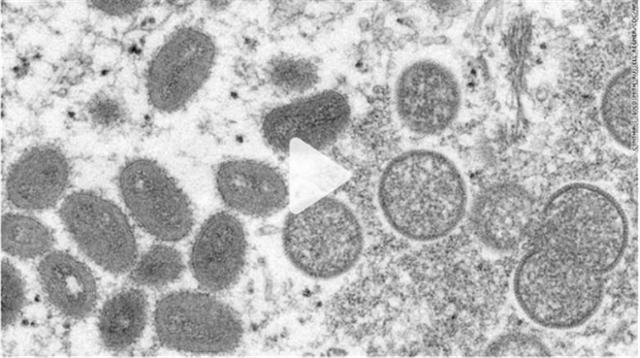 警惕：猴痘蔓延美国7个州 潜伏期7至14天
